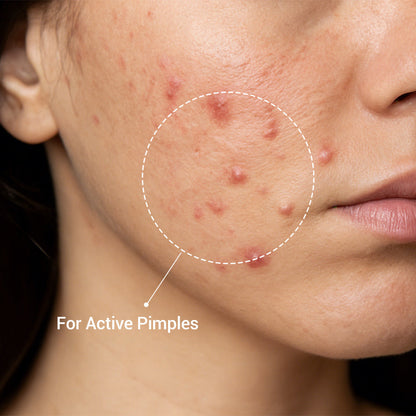 The Acne Buster™ Drying Lotion Plus (1.8% Encapsulat