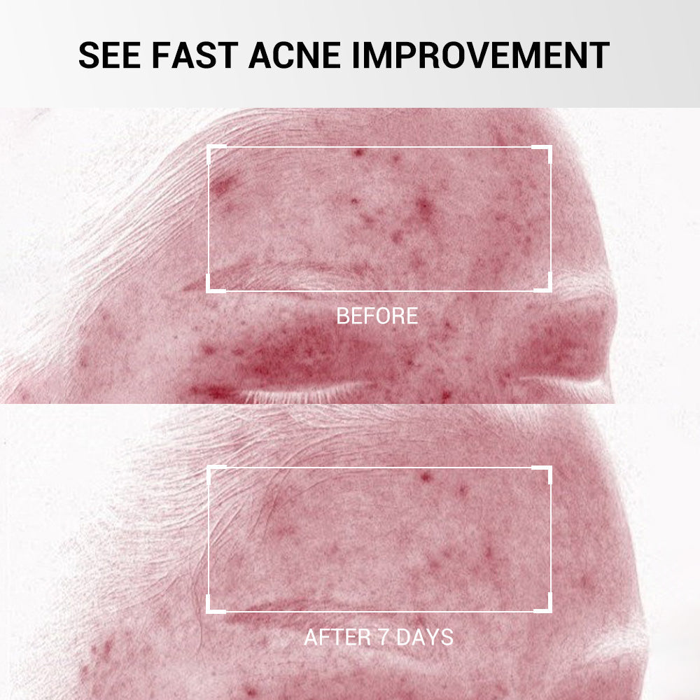 The Acne Buster™ Drying Lotion Plus (1.8% Encapsulat
